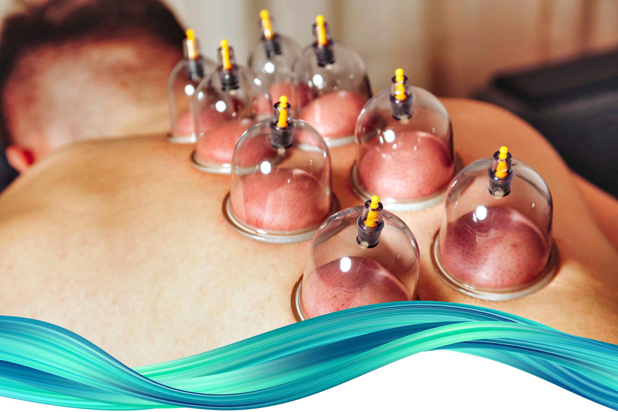 Cupping therapy