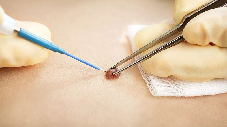 skin tag removal